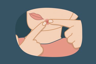 Illustration of a person popping a pimple on their face
