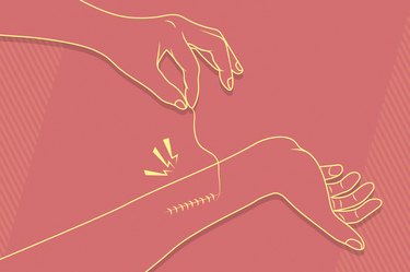 Illustration of person removing stitches from their own arm.